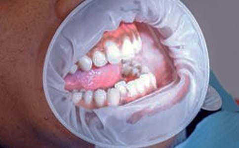 专家支招解决孕期牙龈出血